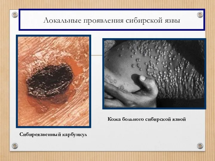 Локальные проявления сибирской язвы Сибиреязвенный карбункул Кожа больного сибирской язвой