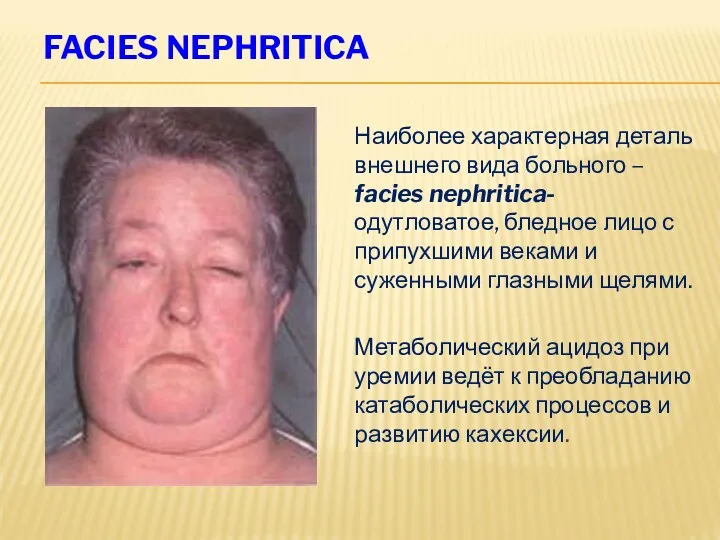 FACIES NEPHRITICA Наиболее характерная деталь внешнего вида больного – facies