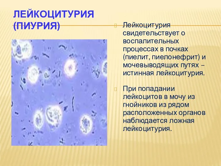 ЛЕЙКОЦИТУРИЯ (ПИУРИЯ) Лейкоцитурия свидетельствует о воспалительных процессах в почках (пиелит,