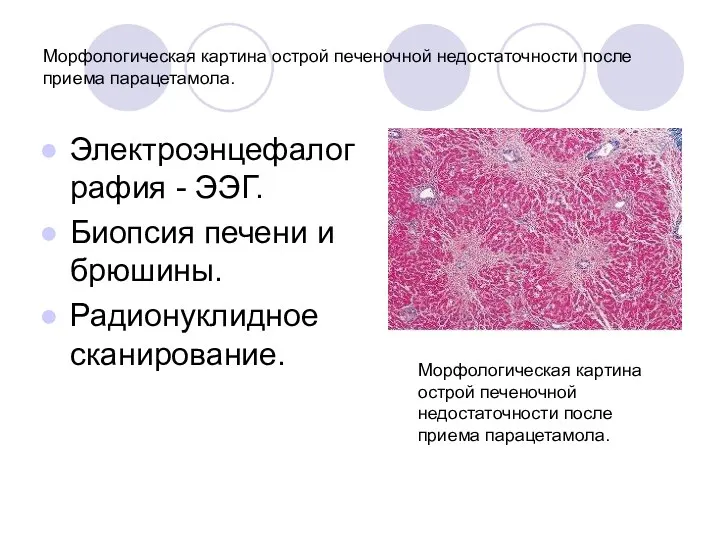 Морфологическая картина острой печеночной недостаточности после приема парацетамола. Электроэнцефалография - ЭЭГ. Биопсия печени