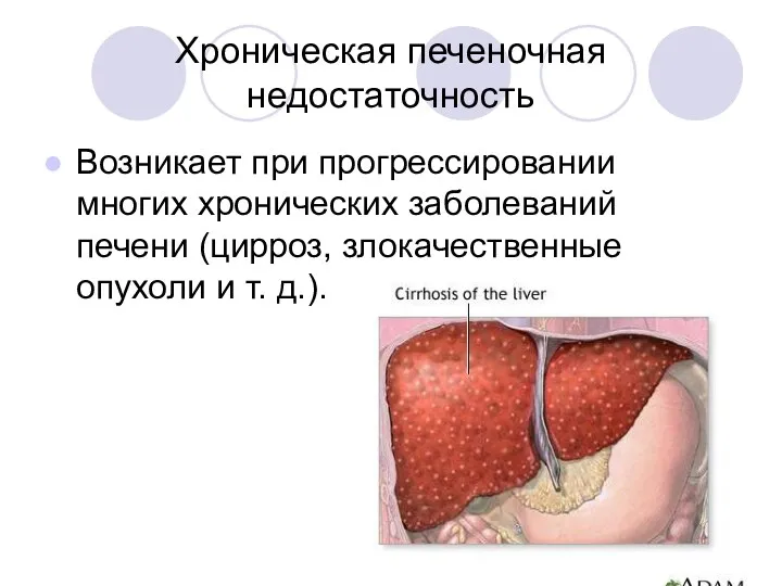 Хроническая печеночная недостаточность Возникает при прогрессировании многих хронических заболеваний печени (цирроз, злокачественные опухоли и т. д.).