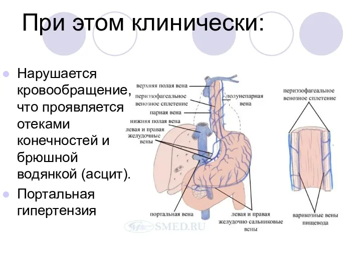 При этом клинически: Нарушается кровообращение, что проявляется отеками конечностей и брюшной водянкой (асцит). Портальная гипертензия