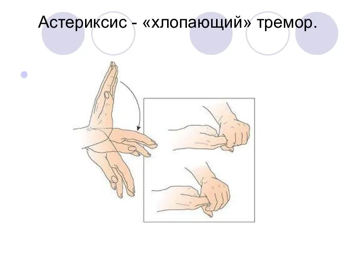 Астериксис - «хлопающий» тремор.