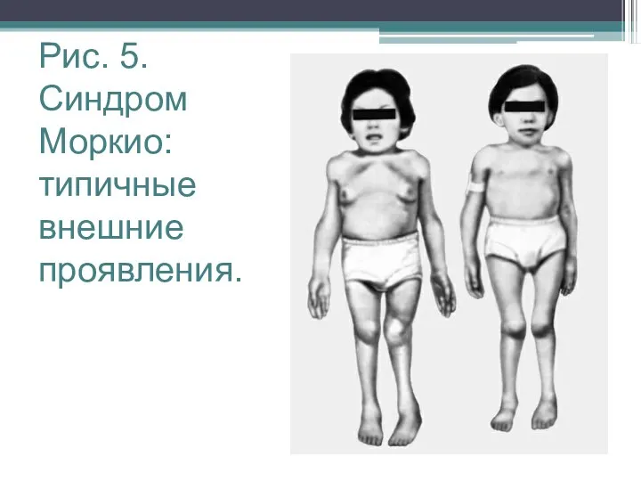 Рис. 5. Синдром Моркио: типичные внешние проявления.