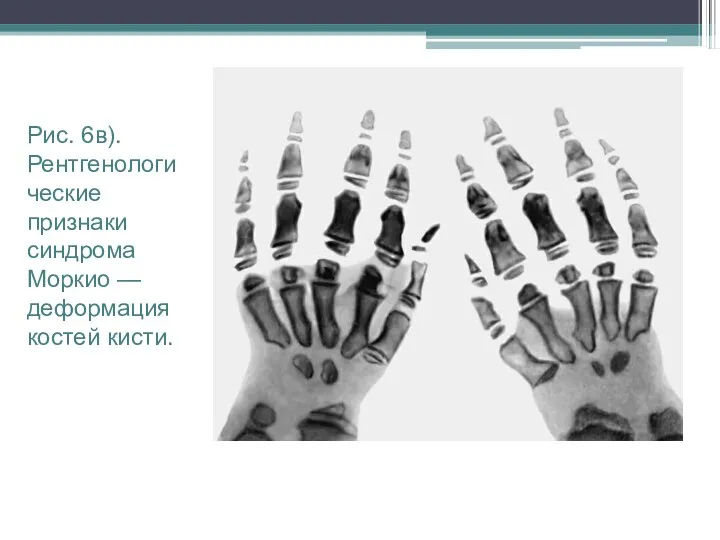 Рис. 6в). Рентгенологические признаки синдрома Моркио — деформация костей кисти.