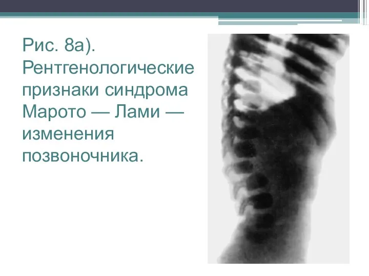 Рис. 8а). Рентгенологические признаки синдрома Марото — Лами — изменения позвоночника.