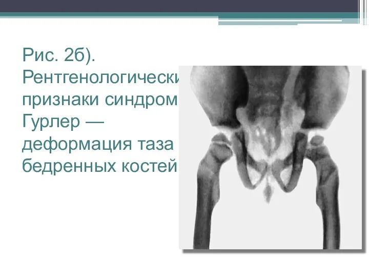 Рис. 2б). Рентгенологические признаки синдрома Гурлер — деформация таза и бедренных костей.