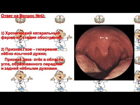 Ответ на Вопрос №42: 1) Хронический катаральный фарингит, стадия обострения;