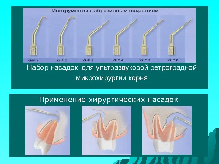 Набор насадок для ультразвуковой ретроградной микрохирургии корня Применение хирургических насадок