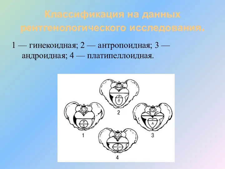 Классификация на данных рентгенологического исследования. 1 — гинекоидная; 2 —