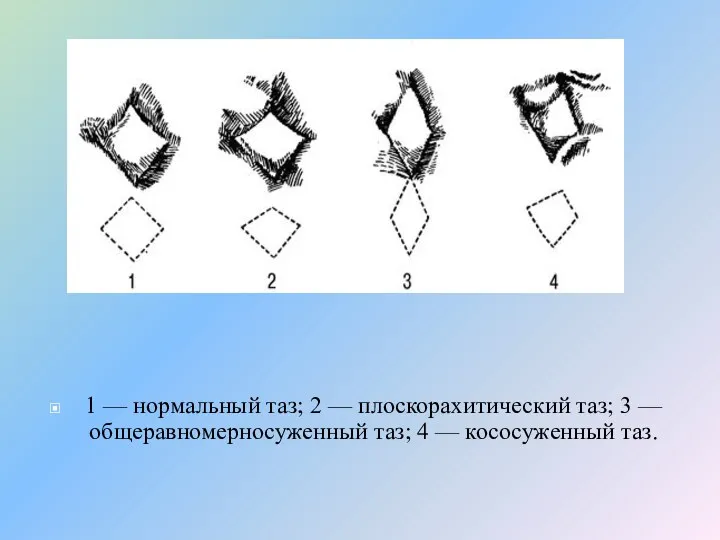 1 — нормальный таз; 2 — плоскорахитический таз; 3 — общеравномерносуженный таз; 4 — кососуженный таз.