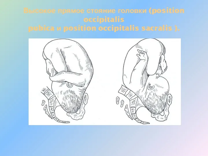 Высокое прямое стояние головки (position occipitalis pubica и position occipitalis sacralis ).