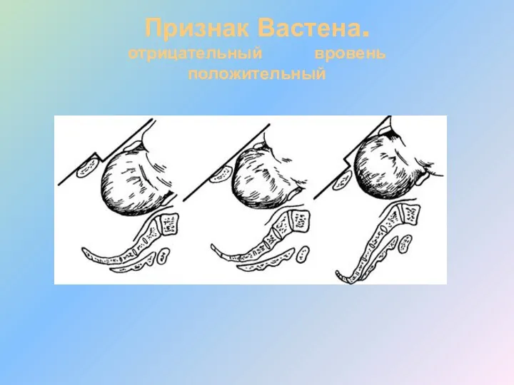 Признак Вастена. отрицательный вровень положительный