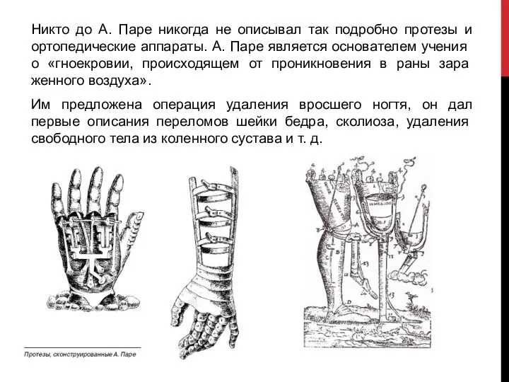 Никто до А. Паре никогда не описывал так подробно протезы и ортопедические аппараты.