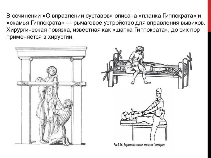В сочинении «О вправлении суставов» описана «планка Гиппократа» и «скамья Гиппократа» — рычаговое