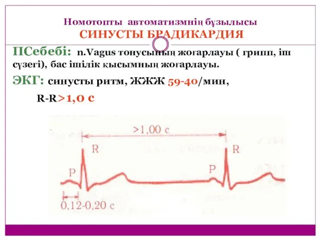 Номотопты автоматизмнің бұзылысы СИНУСТЫ БРАДИКАРДИЯ ПСебебі: n.Vagus тонусының жоғарлауы ( грипп, іш сүзегі),