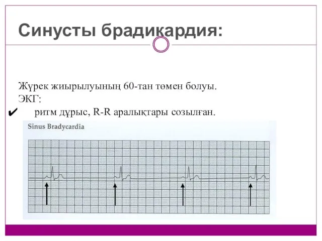 Синусты брадикардия: Жүрек жиырылуының 60-тан төмен болуы. ЭКГ: ритм дұрыс, R-R аралықтары созылған.