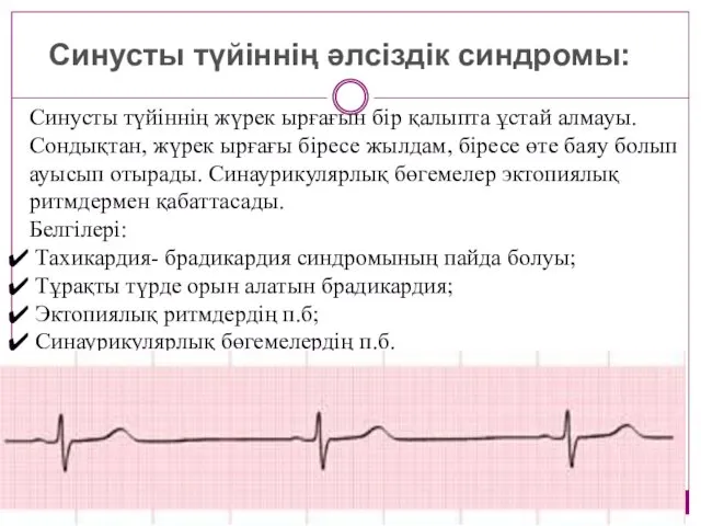 Синусты түйіннің әлсіздік синдромы: Синусты түйіннің жүрек ырғағын бір қалыпта ұстай алмауы. Сондықтан,