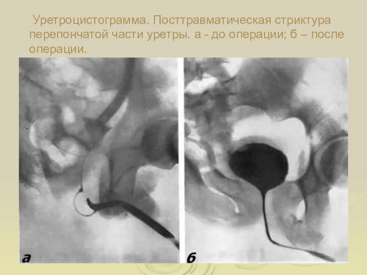 Уретроцистограмма. Посттравматическая стриктура перепончатой части уретры. а - до операции; б – после операции.