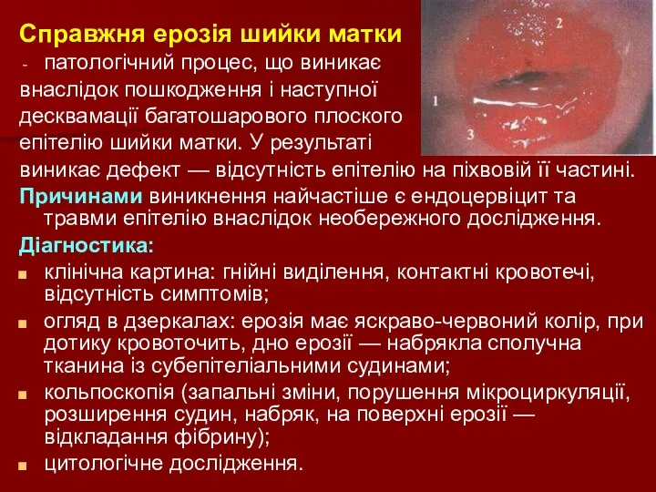 Справжня ерозія шийки матки патологічний процес, що виникає внаслідок пошкодження