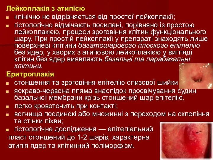 Лейкоплакія з атипією клінічно не відрізняється від простої лейкоплакії; гістологічно