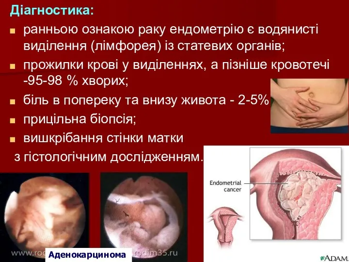 Діагностика: ранньою ознакою раку ендометрію є водянисті виділення (лімфорея) із