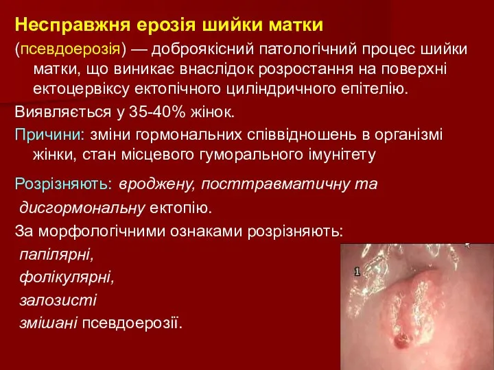 Несправжня ерозія шийки матки (псевдоерозія) — доброякісний патологічний процес шийки