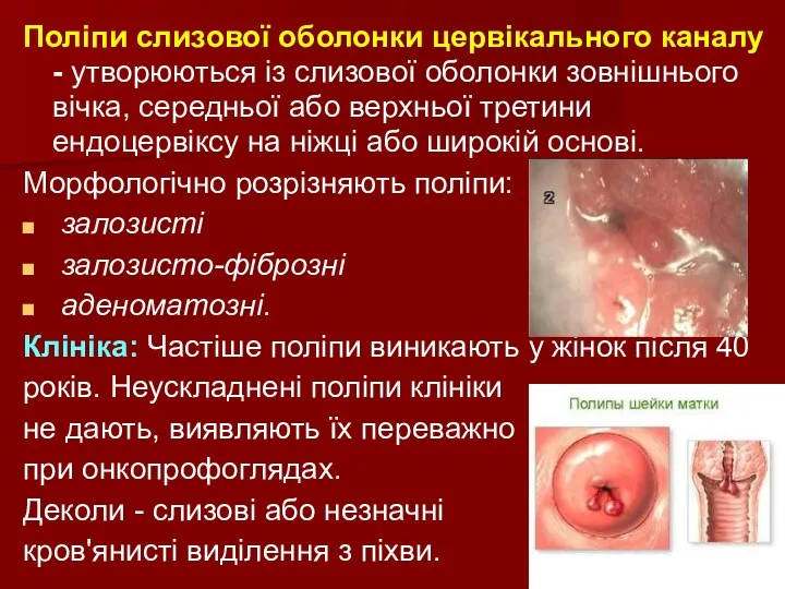 Поліпи слизової оболонки цервікального каналу - утворюються із слизової оболонки