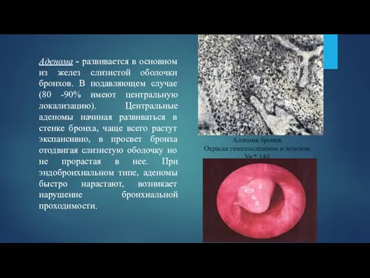 Аденома - развивается в основном из желез слизистой оболочки бронхов.