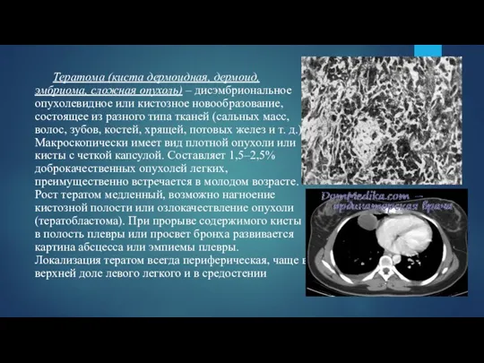 Тератома (киста дермоидная, дермоид, эмбриома, сложная опухоль) – дисэмбриональное опухолевидное или кистозное новообразование,