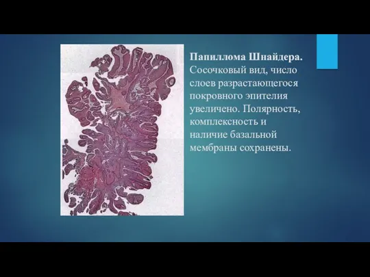 Папиллома Шнайдера. Сосочковый вид, число слоев разрастающегося покровного эпителия увеличено.