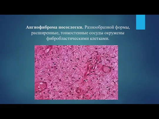 Ангиофиброма носоглотки. Разнообразной формы, расширенные, тонкостенные сосуды окружены фибробластическими клетками.