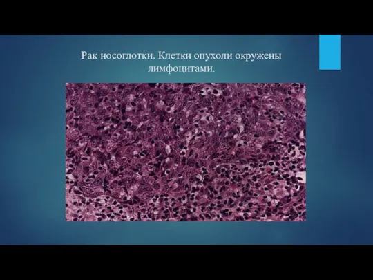 Рак носоглотки. Клетки опухоли окружены лимфоцитами.