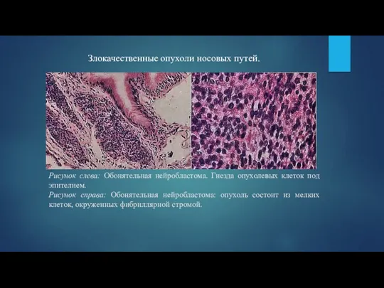 Рисунок слева: Обонятельная нейробластома. Гнезда опухолевых клеток под эпителием. Рисунок справа: Обонятельная нейробластома: