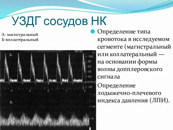 УЗДГ сосудов НК Определение типа кровотока в исследуемом сегменте (магистральный