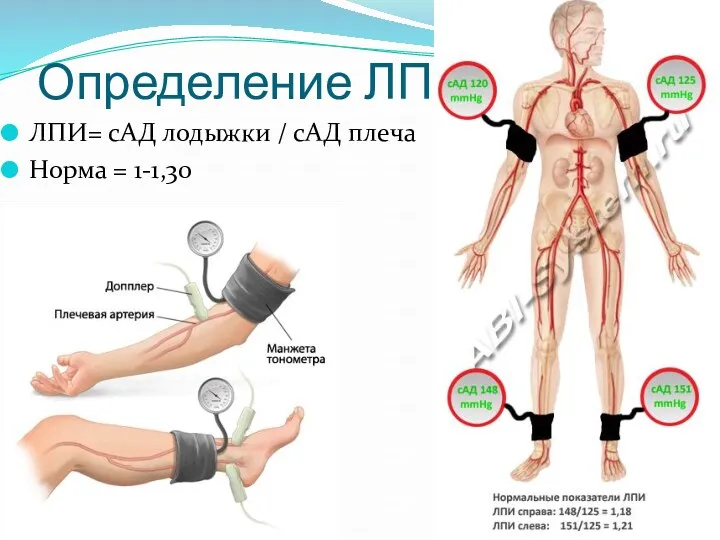 Определение ЛПИ ЛПИ= сАД лодыжки / сАД плеча Норма = 1-1,30