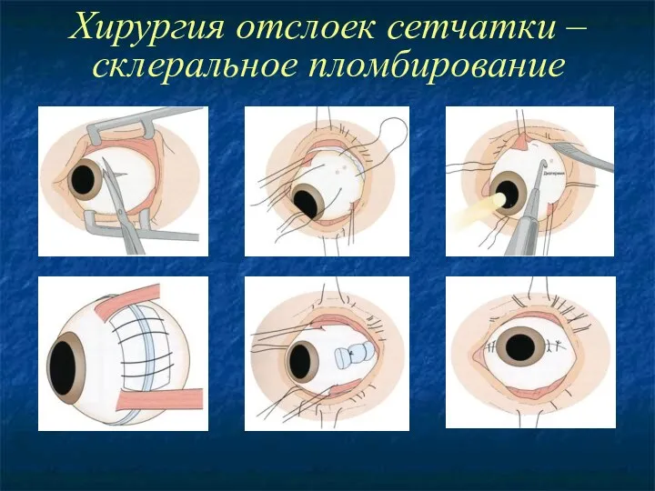 Хирургия отслоек сетчатки – склеральное пломбирование