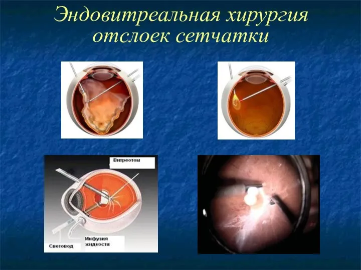 Эндовитреальная хирургия отслоек сетчатки