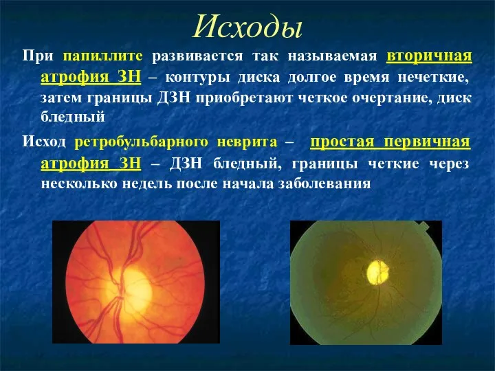Исходы При папиллите развивается так называемая вторичная атрофия ЗН –