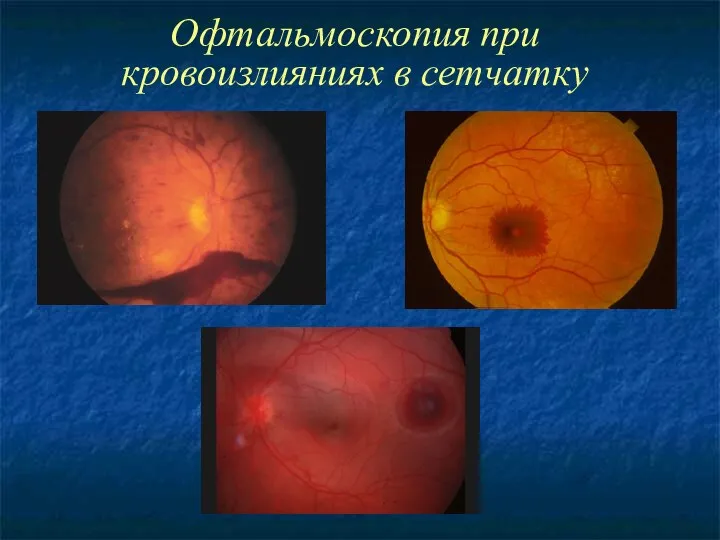 Офтальмоскопия при кровоизлияниях в сетчатку