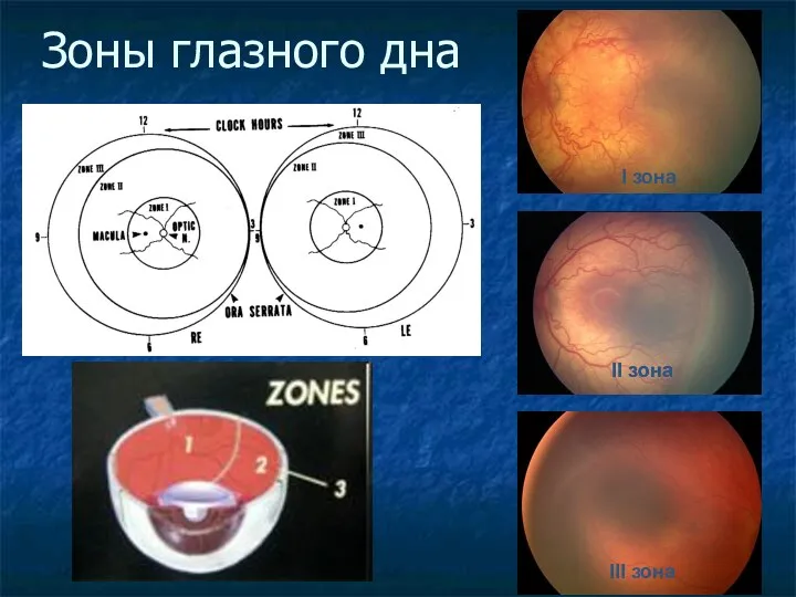 Зоны глазного дна I зона II зона II зона III зона