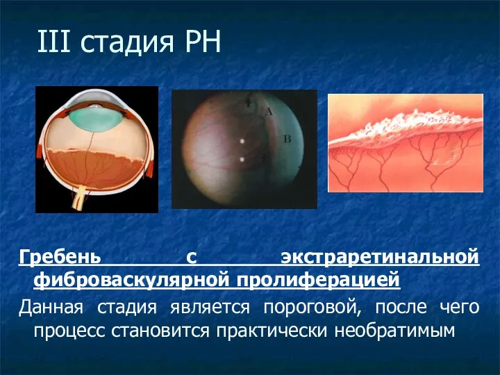 III стадия РН Гребень с экстраретинальной фиброваскулярной пролиферацией Данная стадия