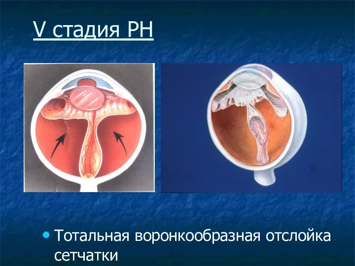 V стадия РН Тотальная воронкообразная отслойка сетчатки 9.