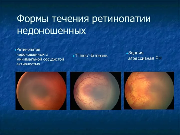Формы течения ретинопатии недоношенных Ретинопатия недоношенных с минимальной сосудистой активностью “Плюс”-болезнь Задняя агрессивная РН