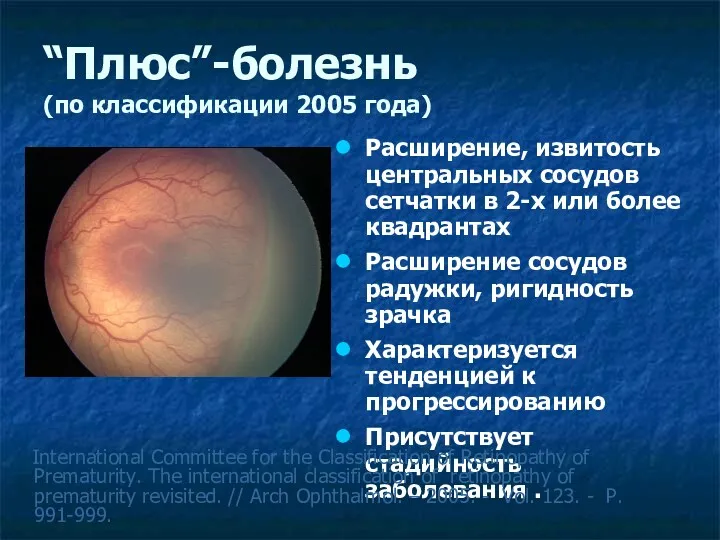 “Плюс”-болезнь (по классификации 2005 года) Расширение, извитость центральных сосудов сетчатки