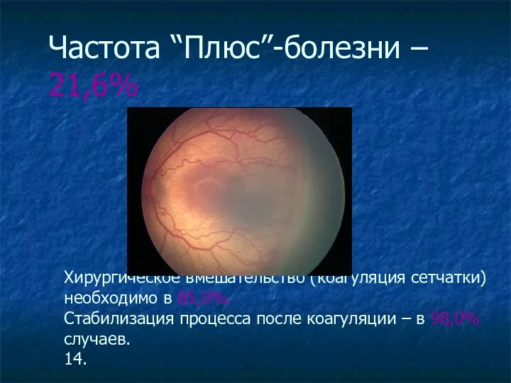 Хирургическое вмешательство (коагуляция сетчатки) необходимо в 85,0%. Стабилизация процесса после