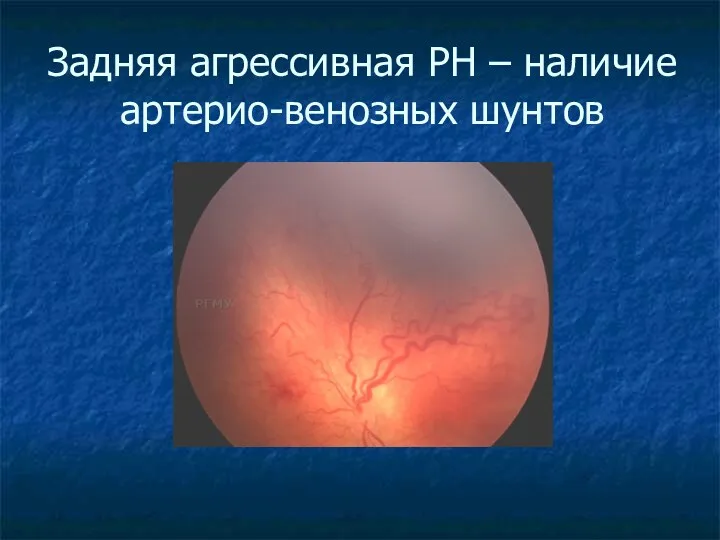 Задняя агрессивная РН – наличие артерио-венозных шунтов