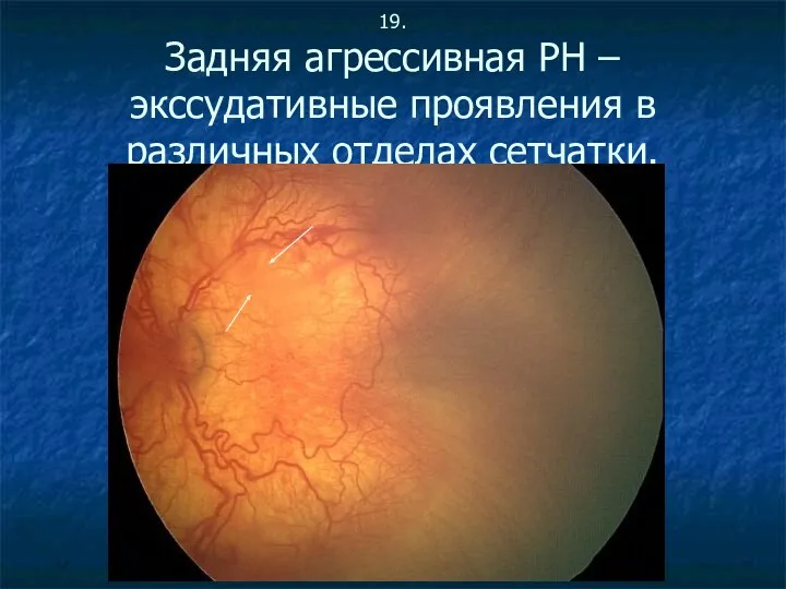 19. Задняя агрессивная РН – экссудативные проявления в различных отделах сетчатки.