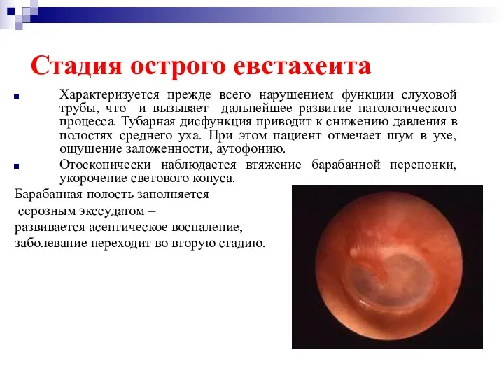 Стадия острого евстахеита Характеризуется прежде всего нарушением функции слуховой трубы, что и вызывает