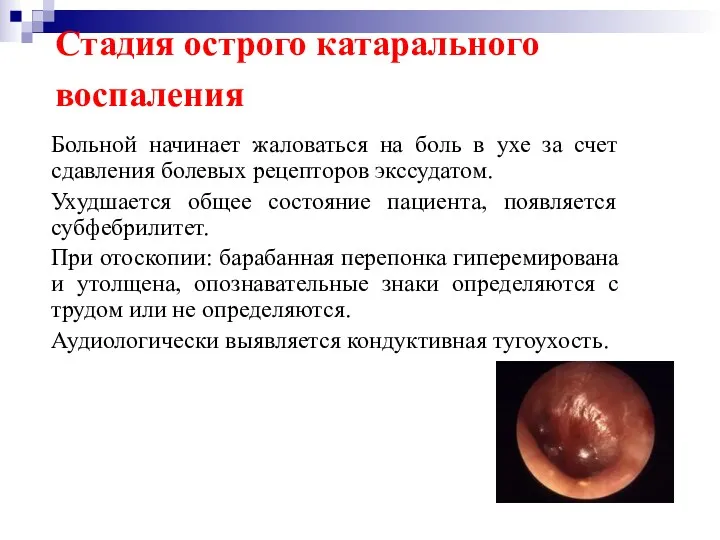 Стадия острого катарального воспаления Больной начинает жаловаться на боль в